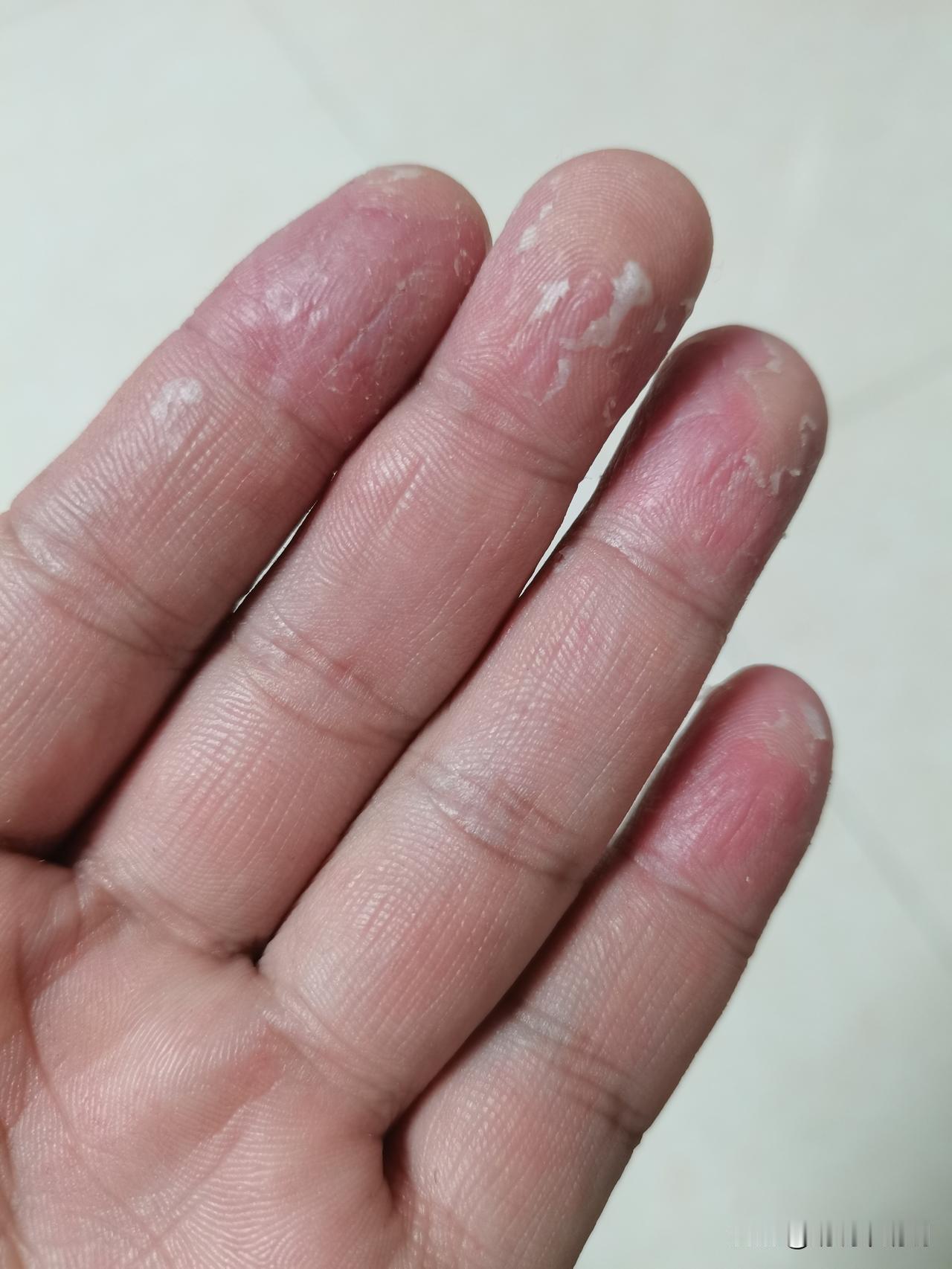 最近手又开始蜕皮了，以前是年年蜕一次，一到了冬季就开始蜕，去年不知道是什么原因了