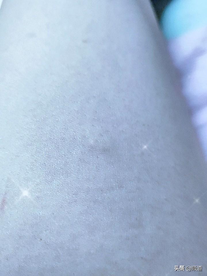 我睡的正香，被一只蚊子给我咬醒了，我最怕蚊子了，也最爱招蚊子。坐起来一顿挠，又陏