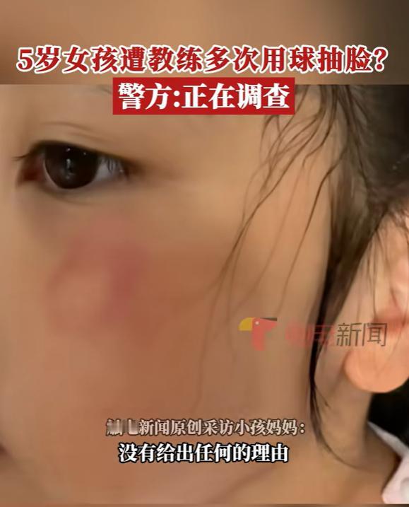 四川成都，女子带5岁女儿学乒乓球，40分钟后发现女儿脸上红肿，晚上回家还低烧，女