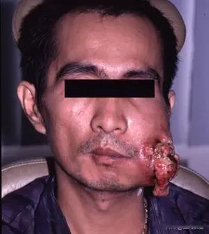 槟榔在2003年的时候就已经被世界卫生组织列为一级致癌物，禁止销售贩卖。这个东西