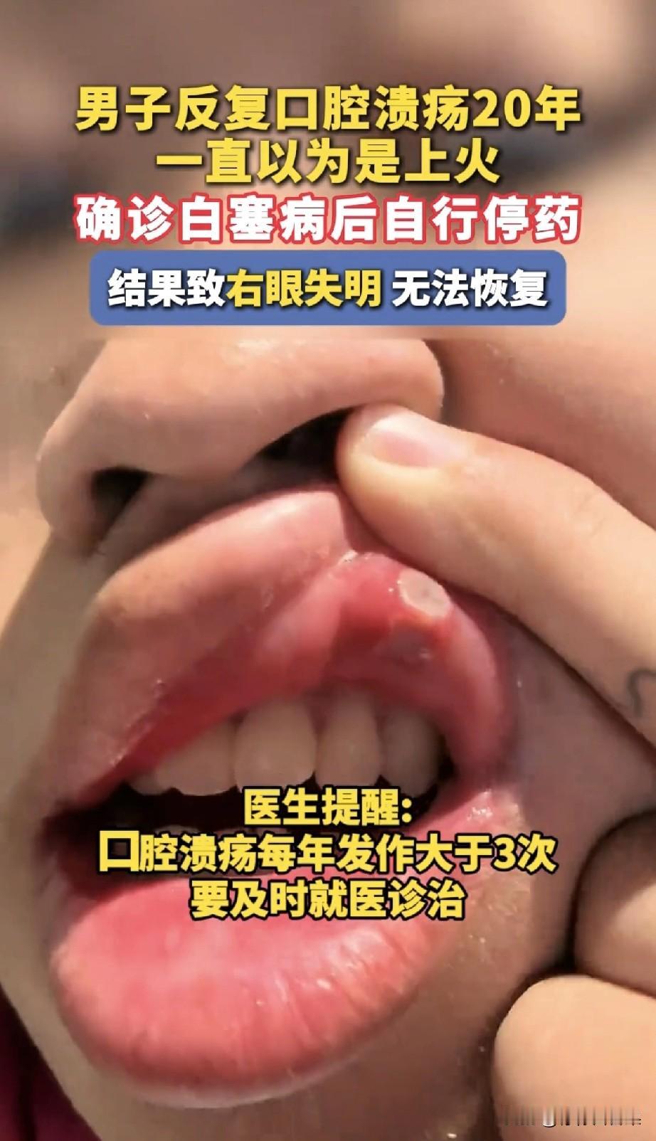 20年口腔溃疡只当是上火，直到右眼彻底失明，这位西安王先生才知道，自己踩了多大的