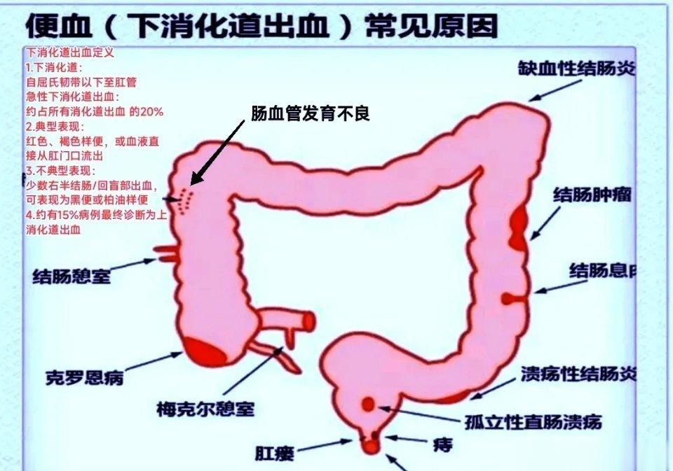 下消化道出血​一.定义：痔、肛裂是最常见的原因，其他常见的病因有肠息肉、结肠癌、