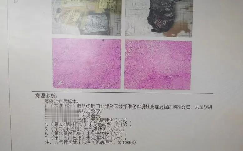 肺癌开刀前一天喊停手术！为何这位老人的儿子要这么做？治疗方案争执不下！要听谁的？