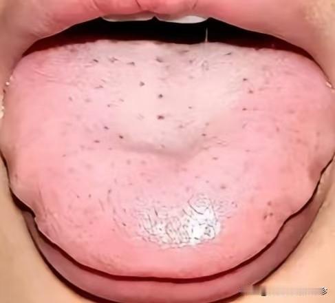 脾虚，人就废了一半，看舌象就知道了！！

今天教你如何判断脾虚舌象

脾虚的人平