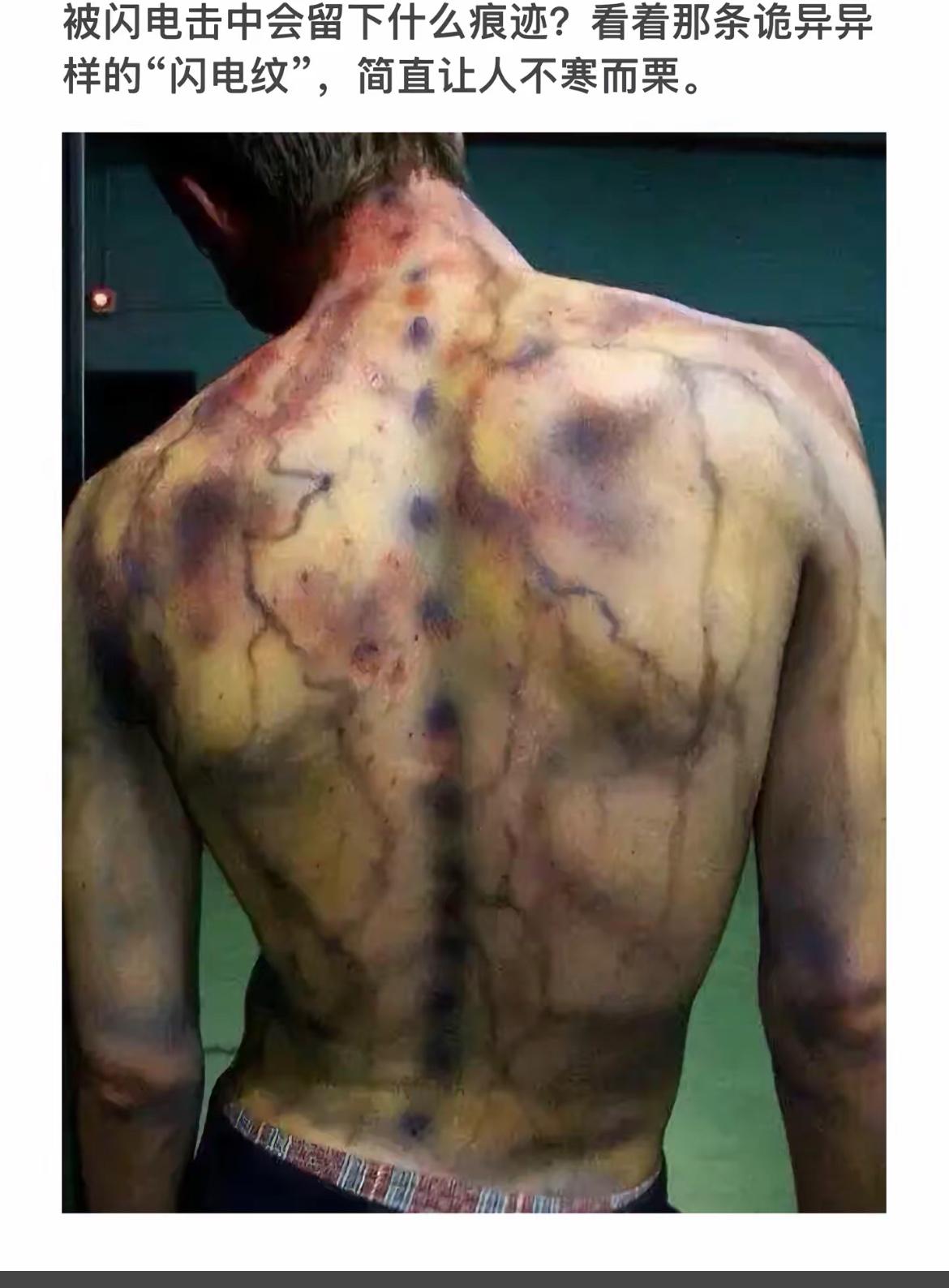 被闪电击中后留下的诡异痕迹，让人不寒而栗！