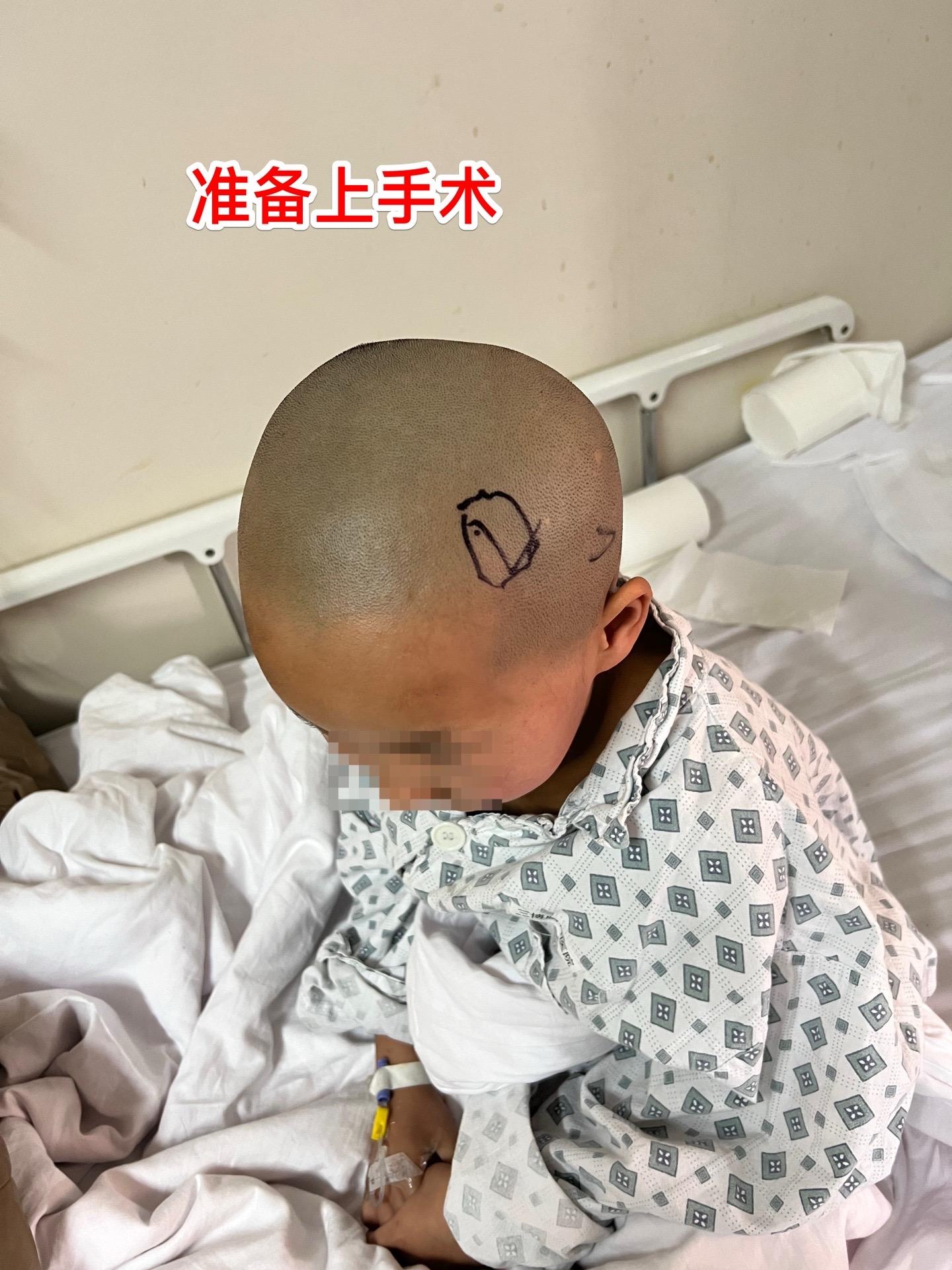 高级别胶质瘤手术后22个月，定期复查。2023年2月28日邯郸市7岁的...