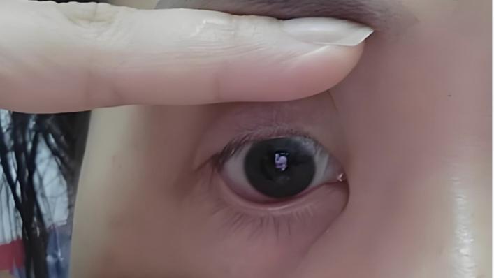 深圳的张先生，今年32岁，近日右眼突然出现了“飞蚊症”现象，视线变得模糊不清。起