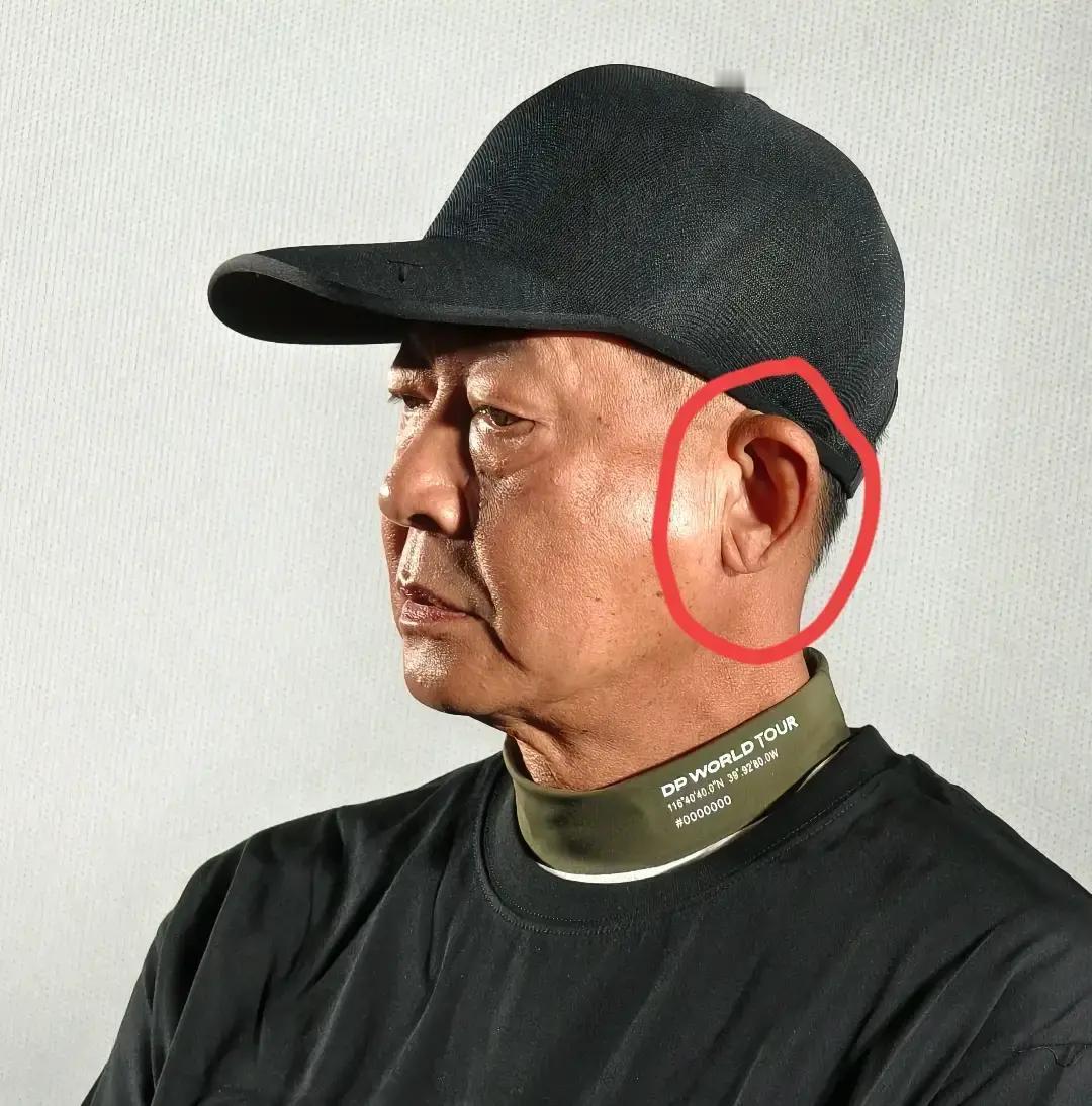 57岁王志文耳垂现深褶
 
一条竖纹把网友吓坏，翻出心梗预警老帖。可皮肤科大夫说