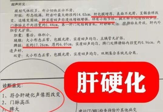 想知道肝脏有没有硬化，关键看这4个数字
1、白蛋白降到30以下：当白蛋白降到30