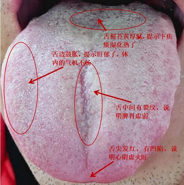 粉丝舌象分析，快来看看与你的舌头是这样的吗？#中医健康##中医学习##中医#