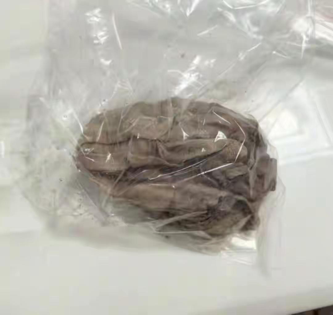 河北女子剖腹产后体内惊现纱布50多天！卫健委回应引热议🔥

邯郸产妇娇娇（化名