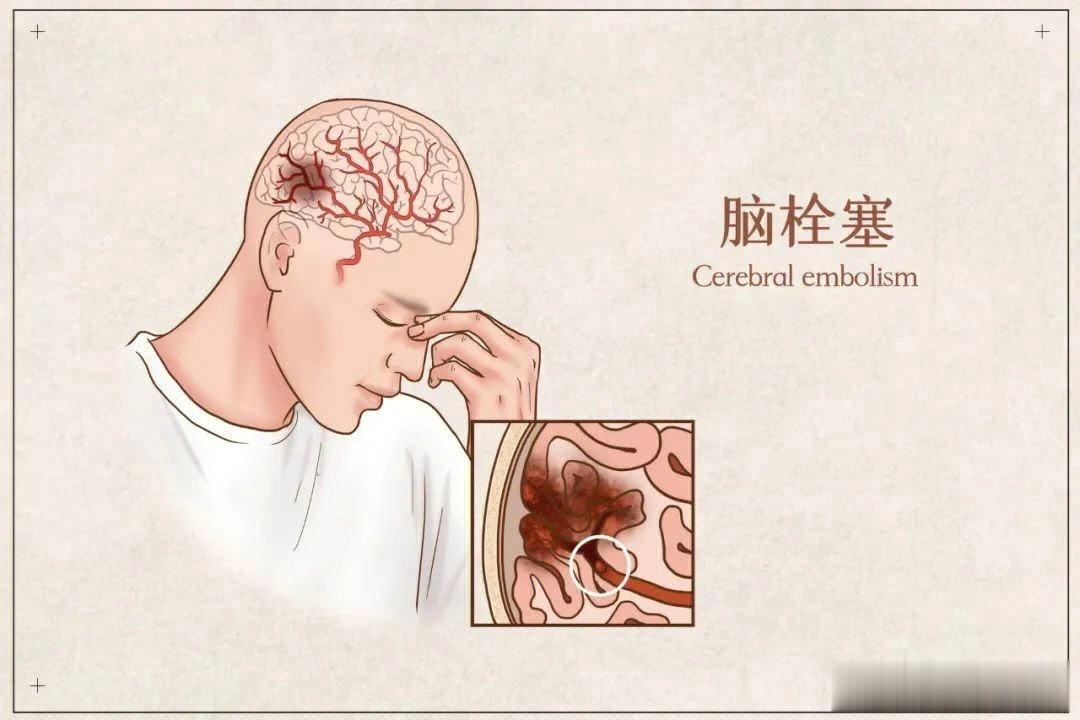 服用旨溶片前先去医院检查1，血脂四项为：( 1 ) 总胆固醇( 2 ) 甘油三酯