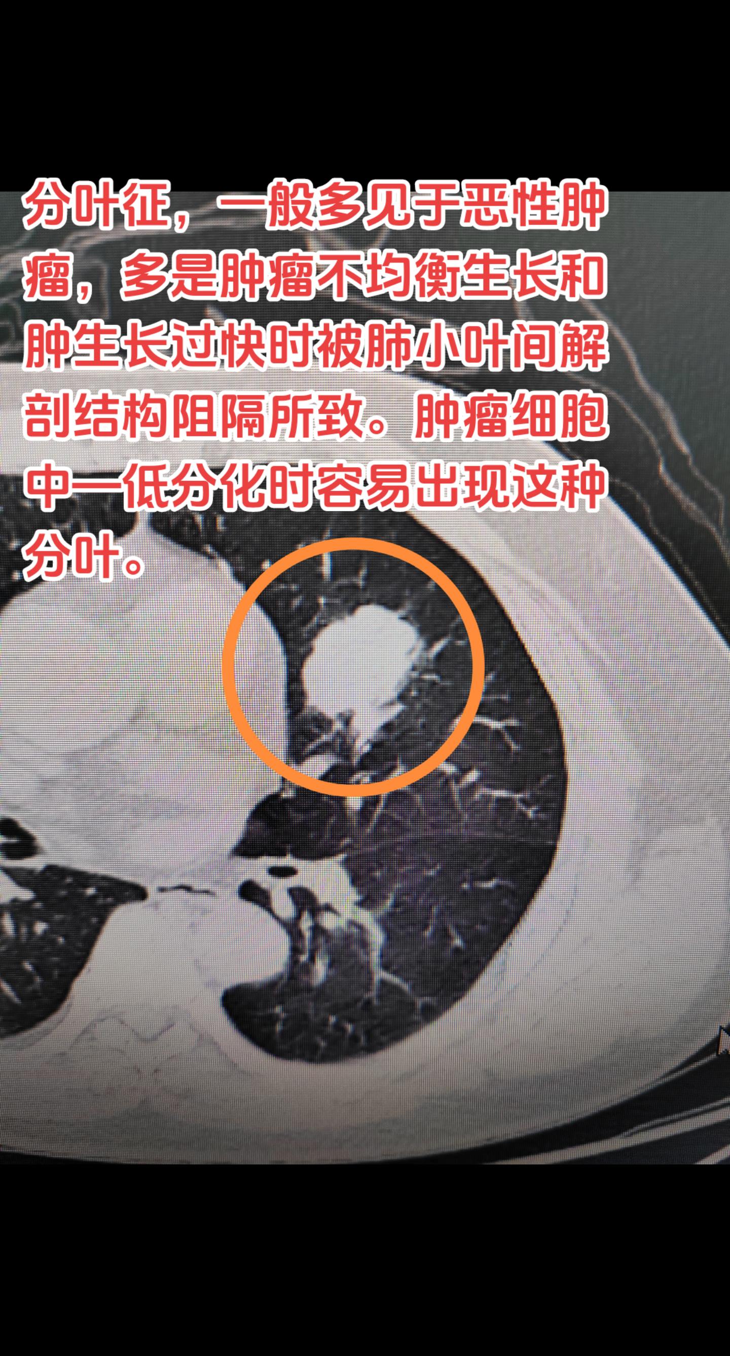 肺肿瘤的分叶征。分叶征，一般多见于恶性肿瘤，多是肿瘤不均衡生长和肿生长过快时被肺小叶间解剖结构阻隔所致。肿瘤细胞中—低分化时容易出现这种分叶。