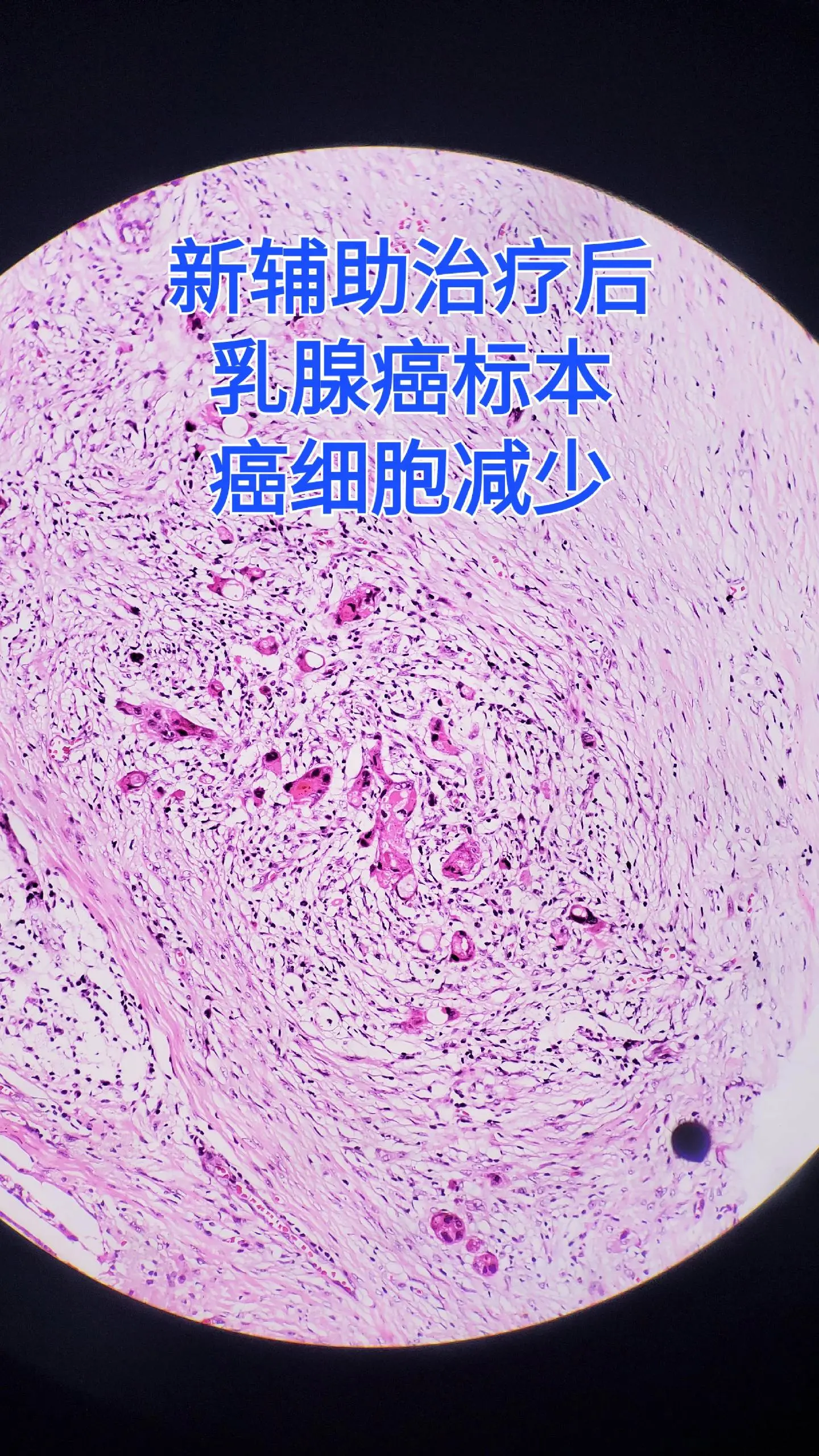 乳腺癌 新辅助化疗