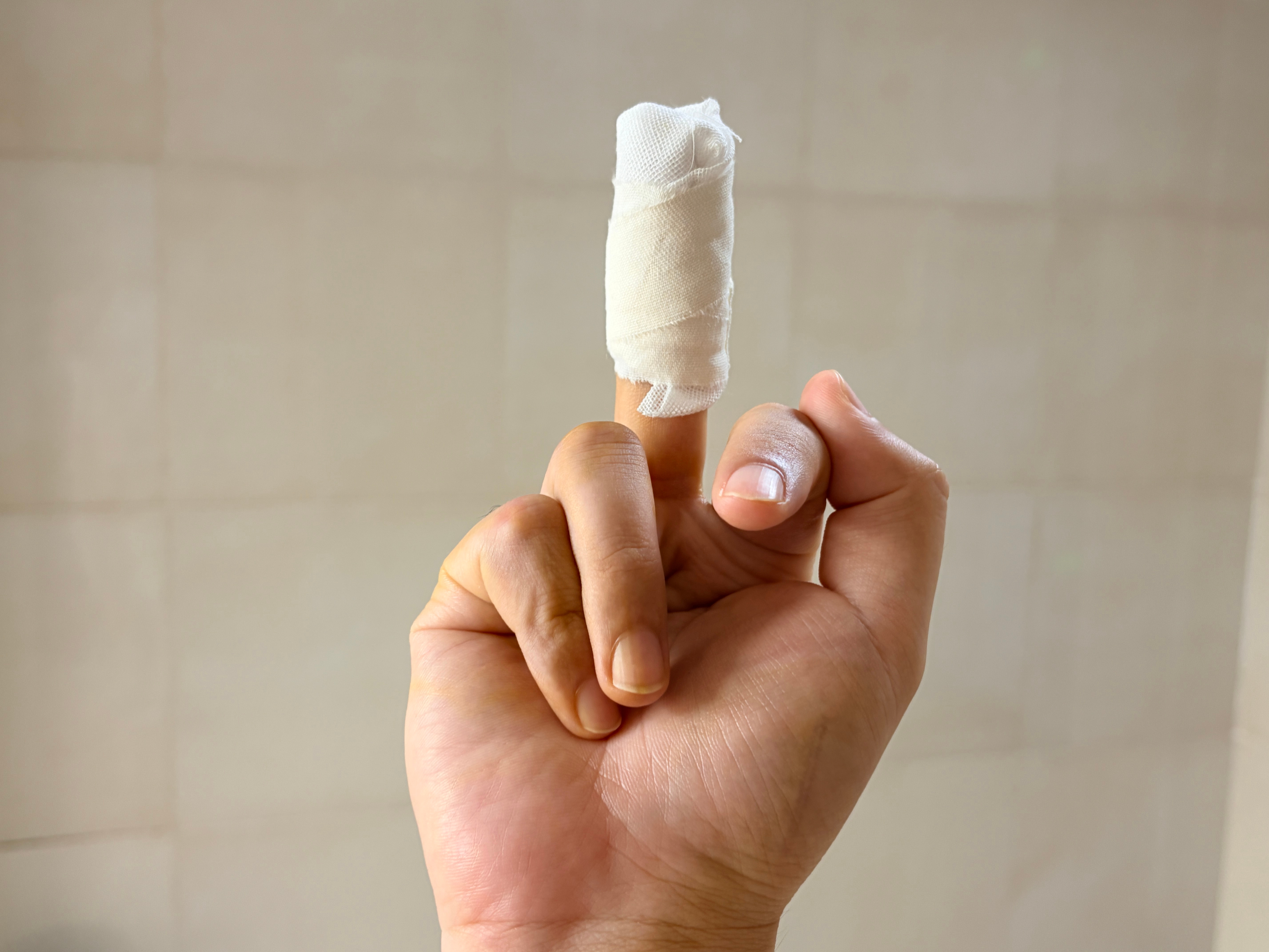 中指的指甲缝扎了一个异物来医院做了个小切口给取出来这种酸爽感谁懂？还好医生手法娴