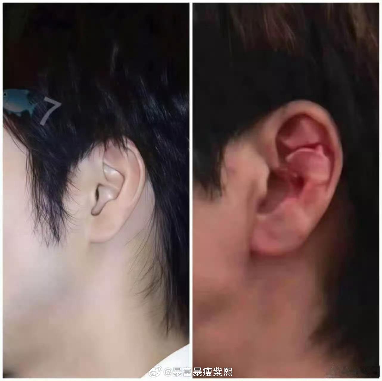 王力宏摔倒  我看了一次视频不敢继续看了，这也太严重了，演出结束要好好处理，好好