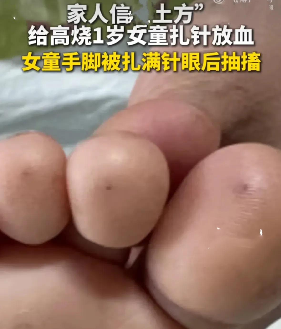 一岁多的女童本应在家人的呵护下健康成长，却因家人的错误行为陷入危险。广东医科大学