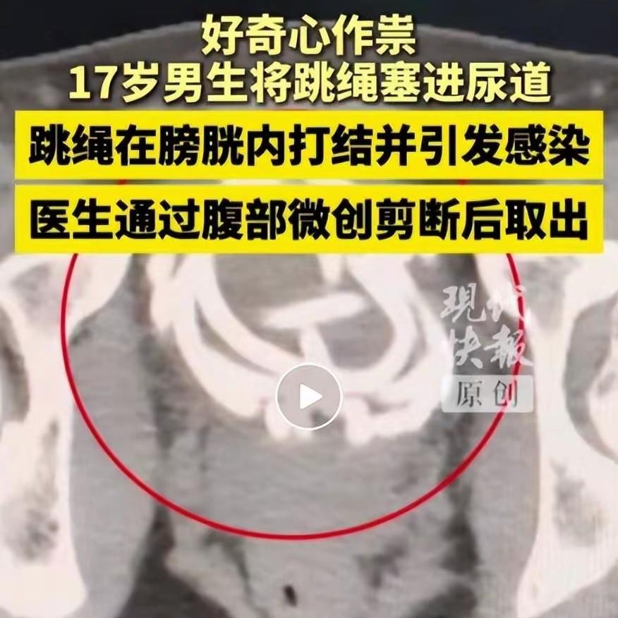 17岁男生将跳绳塞入尿道，
检查结果显示：
尿道黏膜因异物刺激布满脓胎。

  