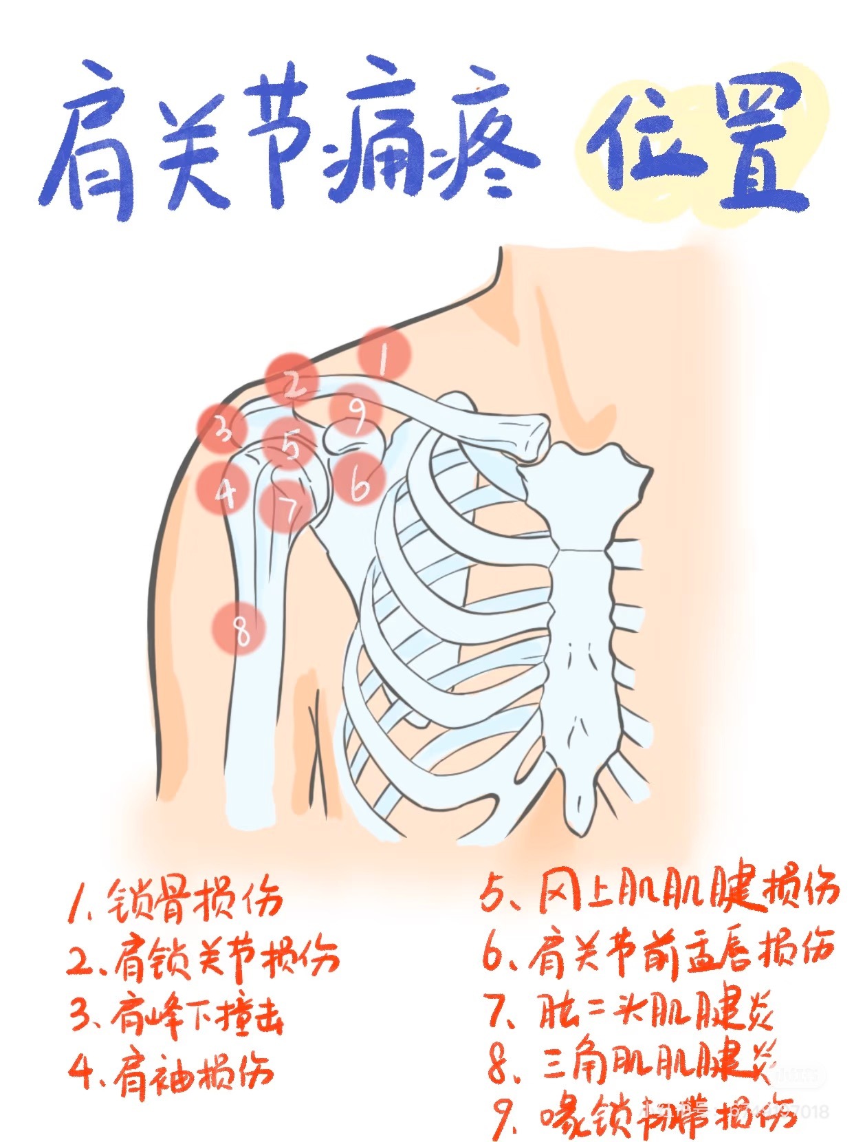 肩膀疼痛 接着来看咱们的肩关节，今天借助一张图，带你更清楚的认识肩部损伤——👉