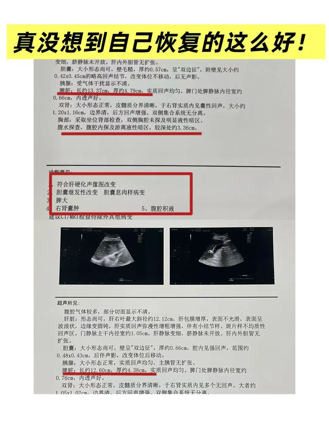 [仙女R]“真没想到自己还能恢复得这么好！”肝硬化失代偿期患者，脾大...