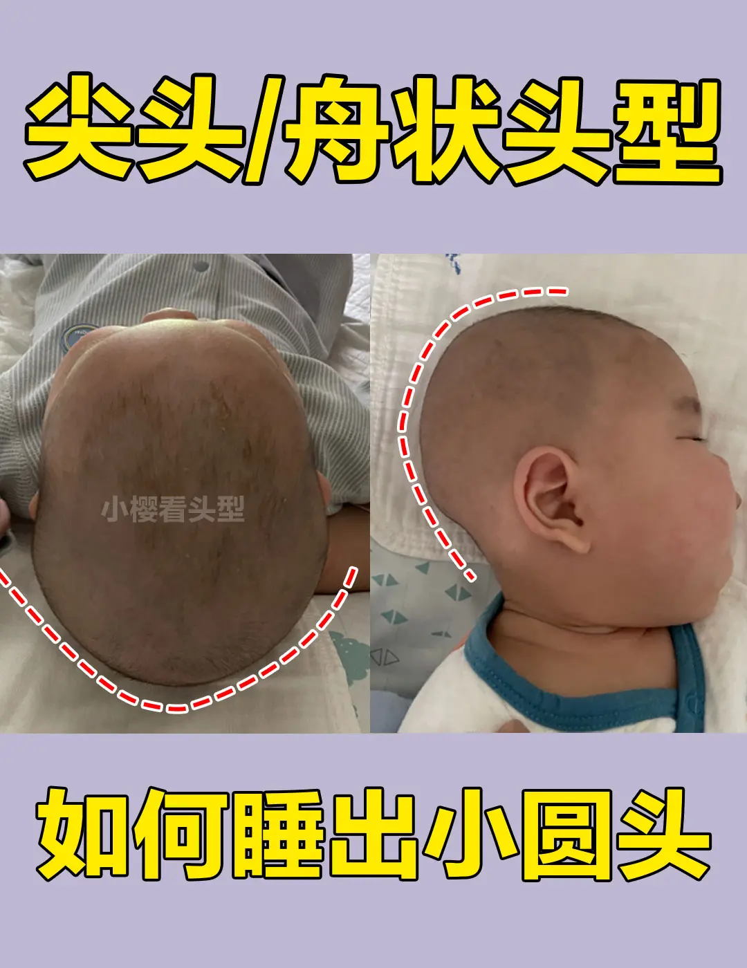 宝宝头型|长头型尖头型如何睡圆头✅附教程 