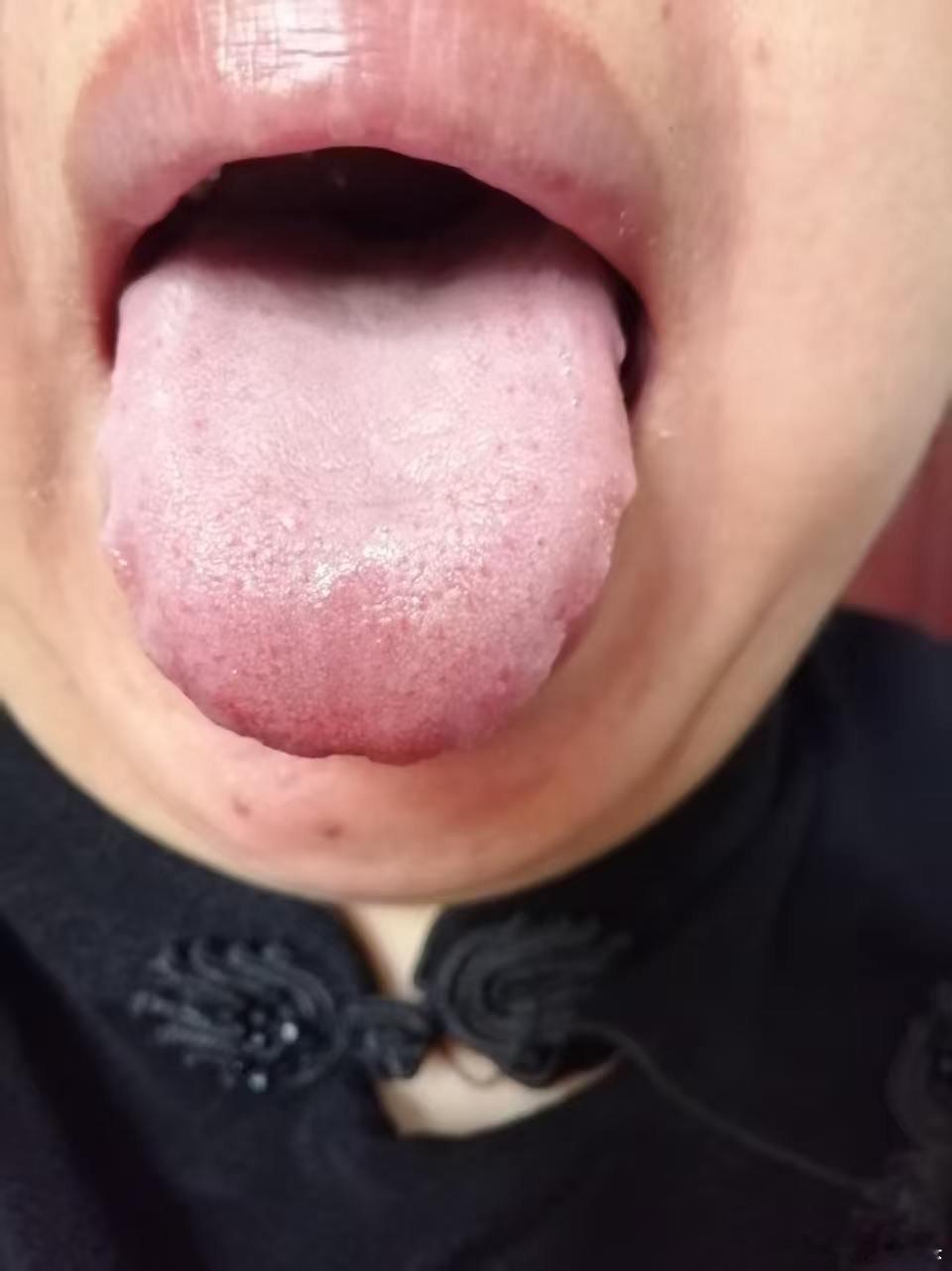 这位同学发的极简医案，体现了子午流注配穴的经典应用。子午流注这一类配穴法，针对因