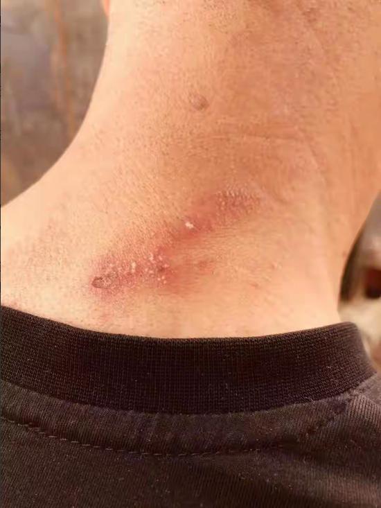 浙江台州，一名 20 多岁男子开窗睡觉，身着宽松短裤入睡。次日，他感觉大腿根隐隐