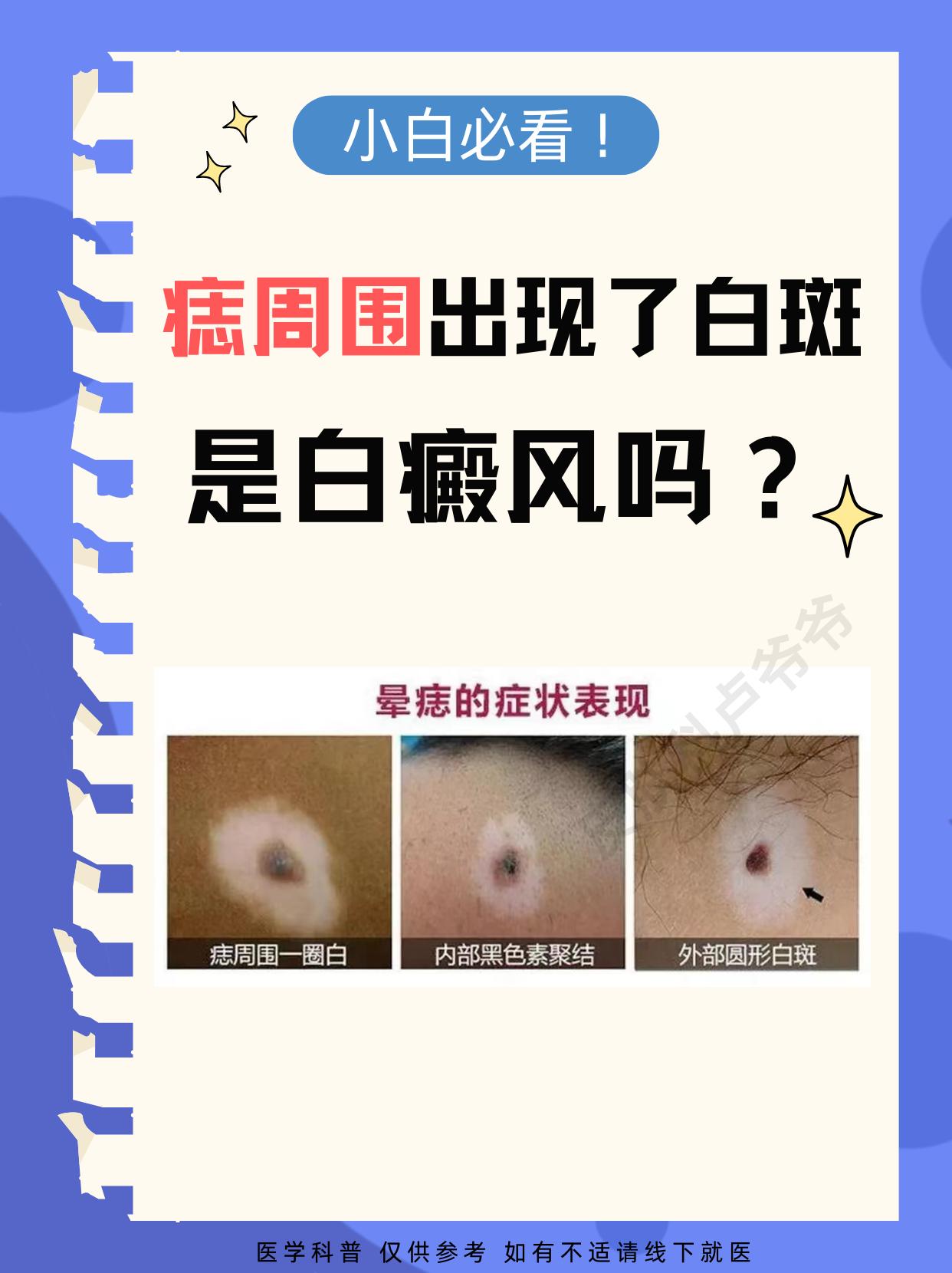 痣周围出现白斑，小心白癜风