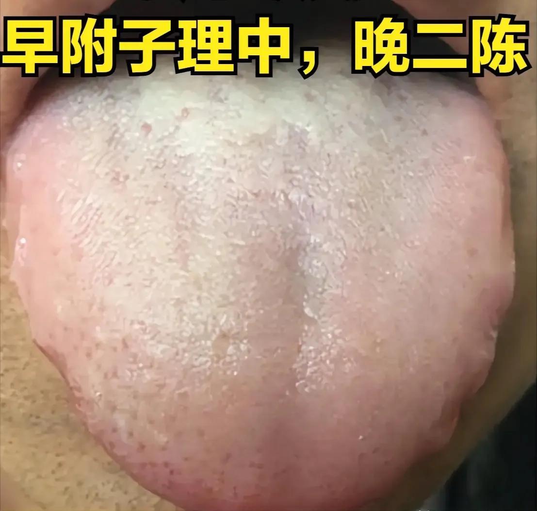 咳嗽痰多、腹胀腹泻腹痛的朋友们，可要注意看这个舌象了！

患者情况：持续咳嗽，咳