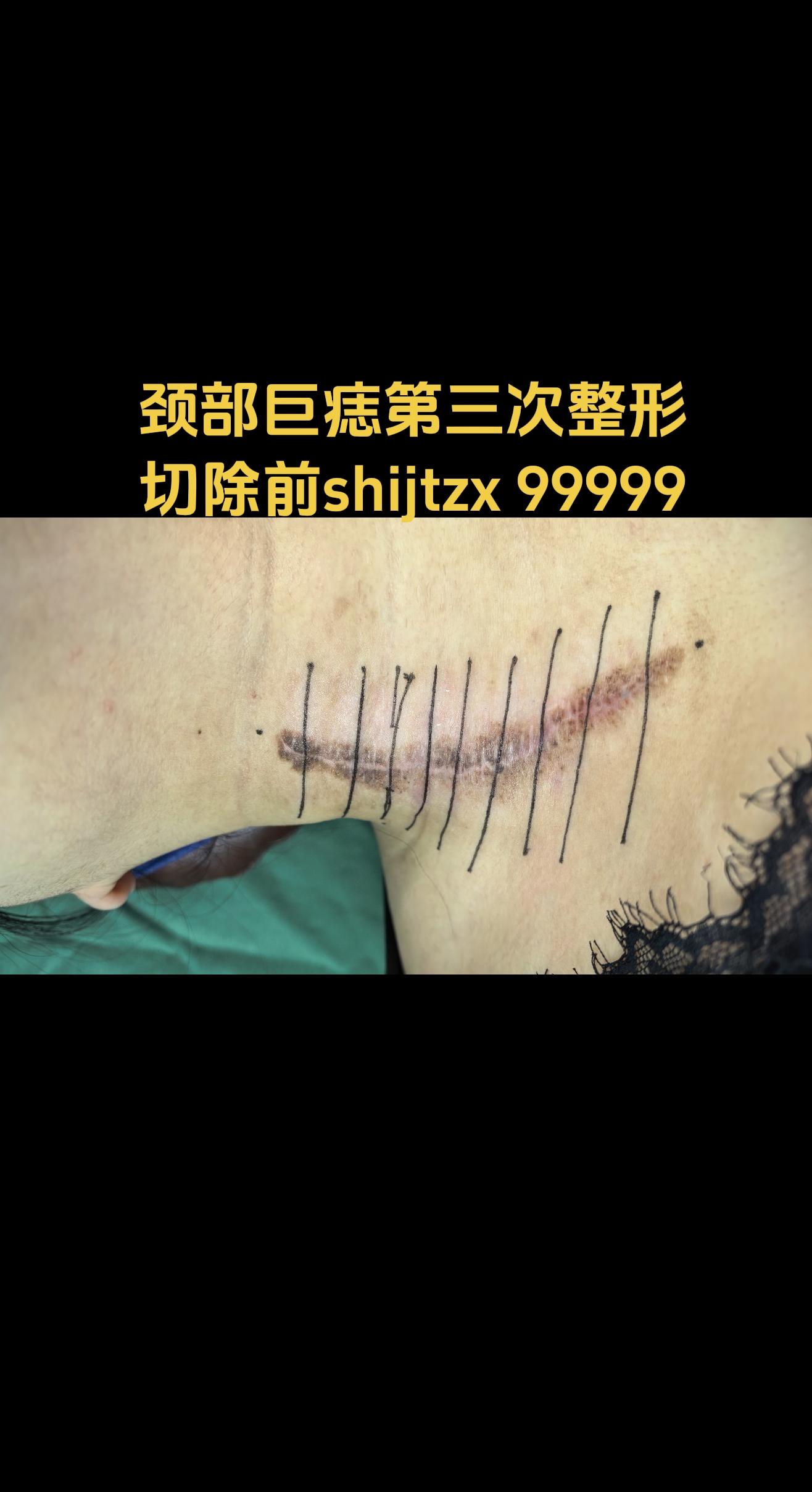 巨痣 巨痣分次整形切除，分层减张缝合。这是3例近期采用分次整形切除方法...