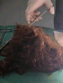 近日，25岁的杭州姑娘佳佳可把人惊到了。她腹胀三四个月，肚子硬得像石头，饭都吃不