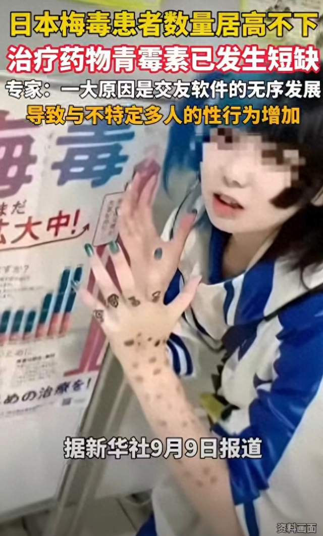 十几年翻十倍！日本梅毒疫情大爆发，特效药还断货