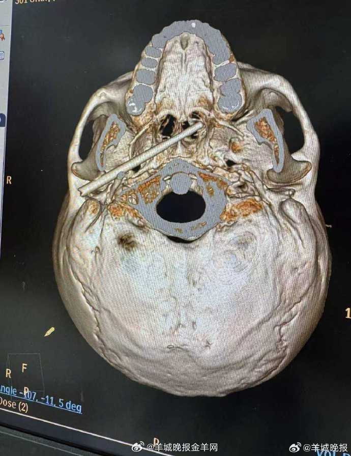 【惊险！#东莞一男子遭筷子贯穿颅底#】东莞一名45岁男子遭筷子贯穿颅底，尖端距大