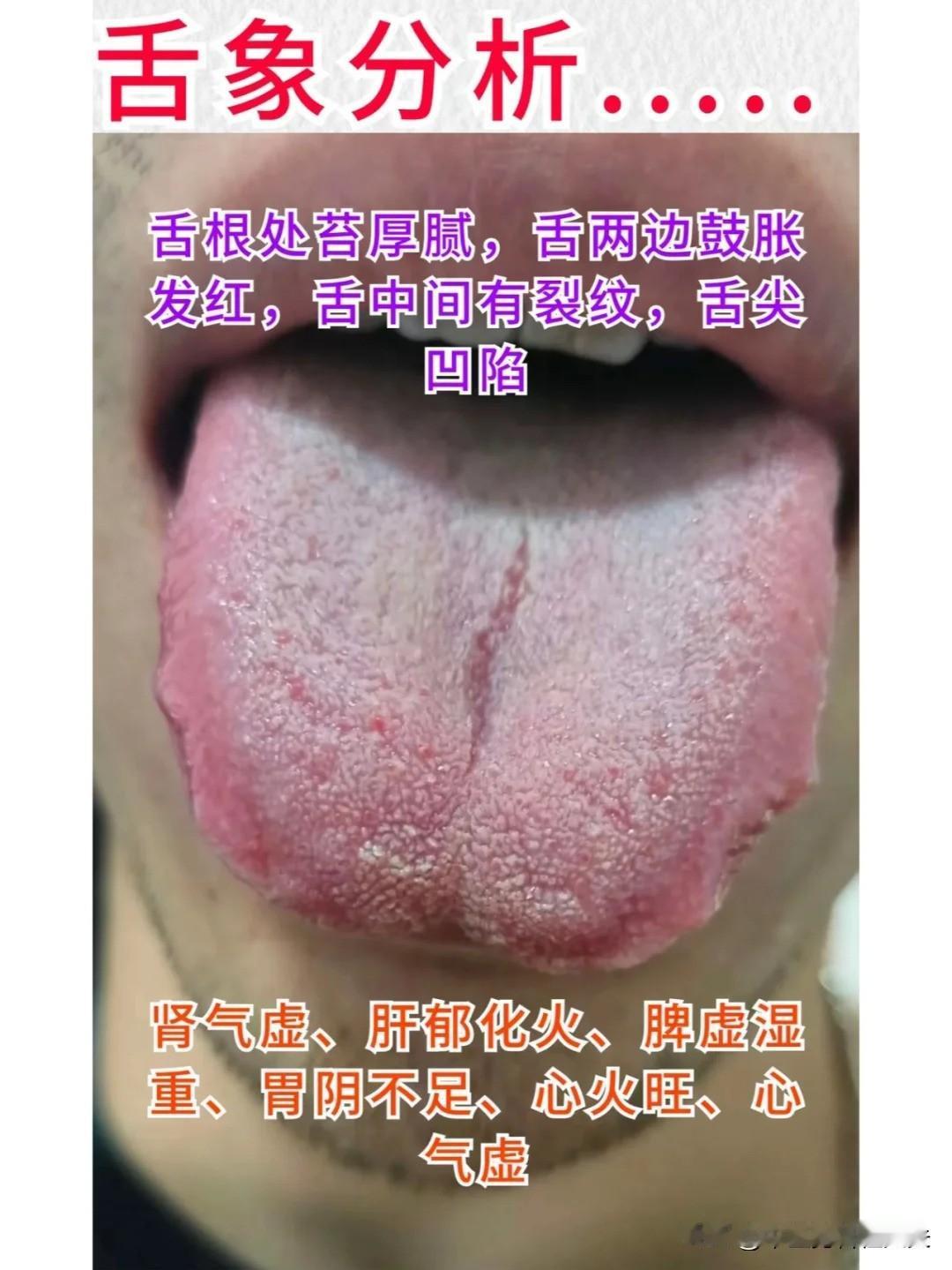 【又到了一日舌象分析，看看你的舌象健康吗？】