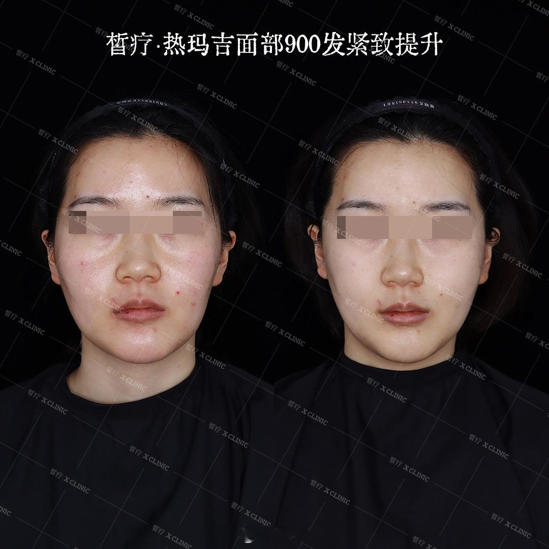 大部分人再怎么皮肉分离、垮垂凹陷都不可能有这位顾客老婆严重的她是因为做了轮廓剥离