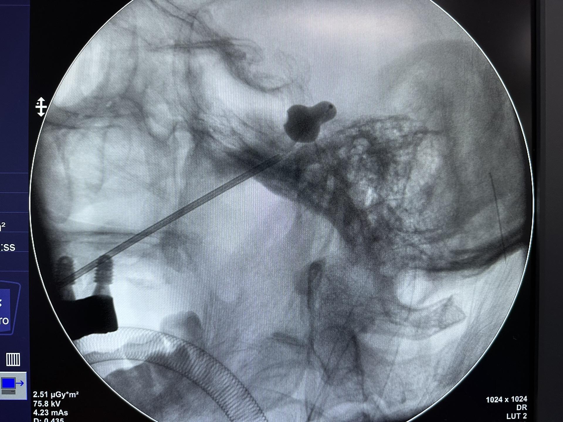🏓型---痛！痛！痛！痛！痛！痛！ 三叉神经痛球囊手术日常，如果身体条件较一般，或者其他原因不能耐受开颅的可以作为其中一个选择！