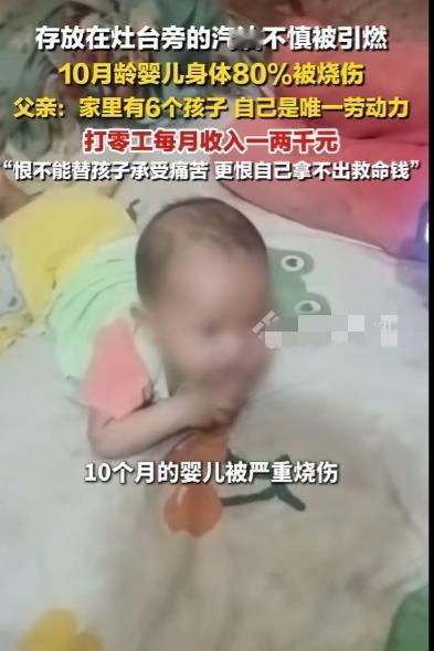 10个月大婴儿被存放在灶台旁的汽油，
造成浑身80%的严重烧伤，
孩子父亲彭先生