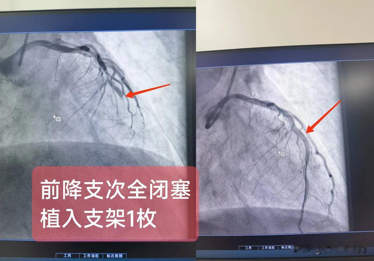 急性ST段抬高型心肌梗死
（前降支次全闭塞)

一.概念：
左前降支走行于室间沟