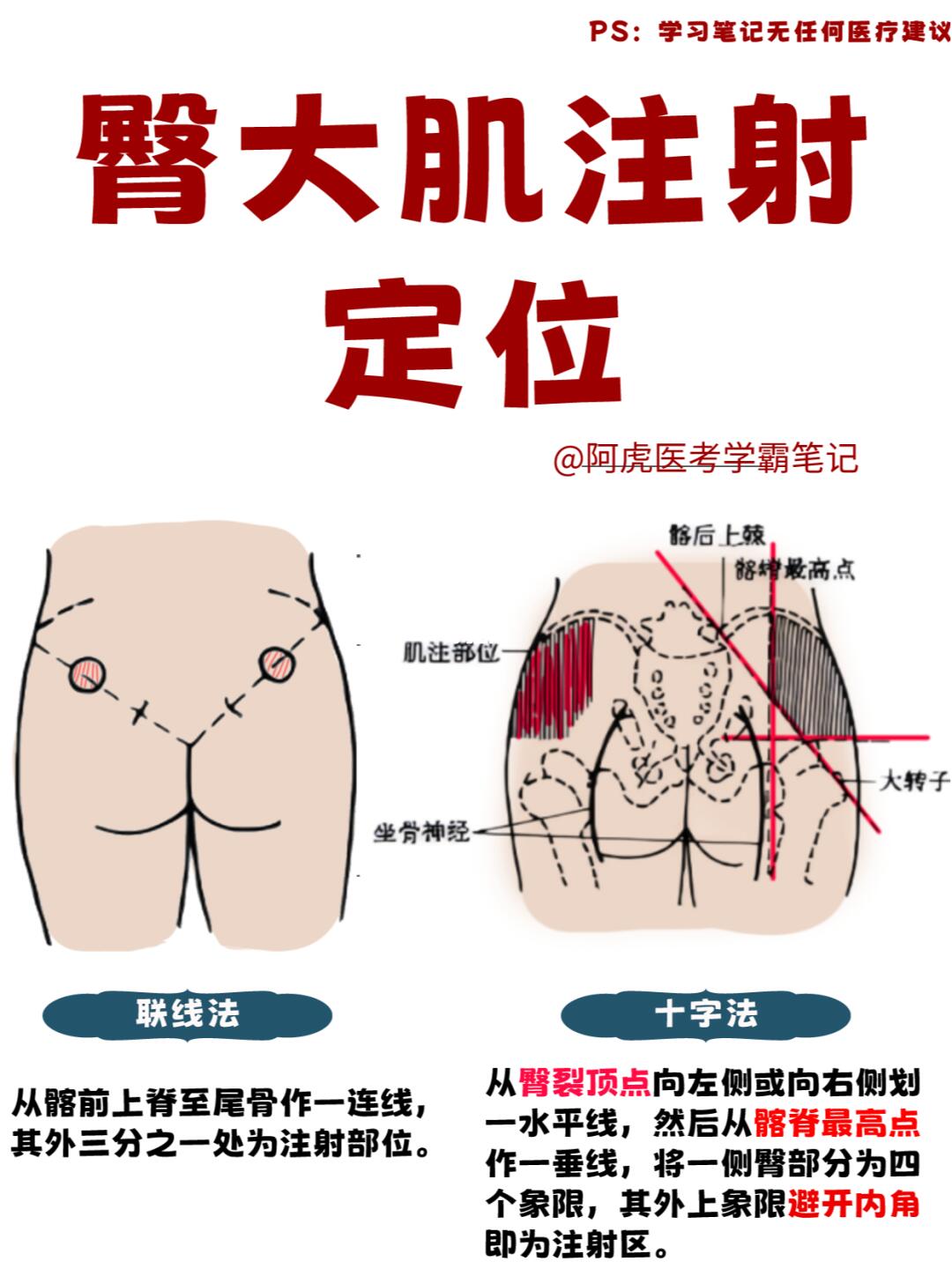 阿虎医考学霸笔记📒臀大肌注射定位法