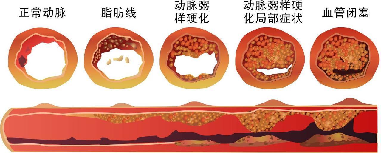 年末护血管，牢记这三点

年关将至，阖家欢聚，这里也提醒大家，务必重视心脑血管问