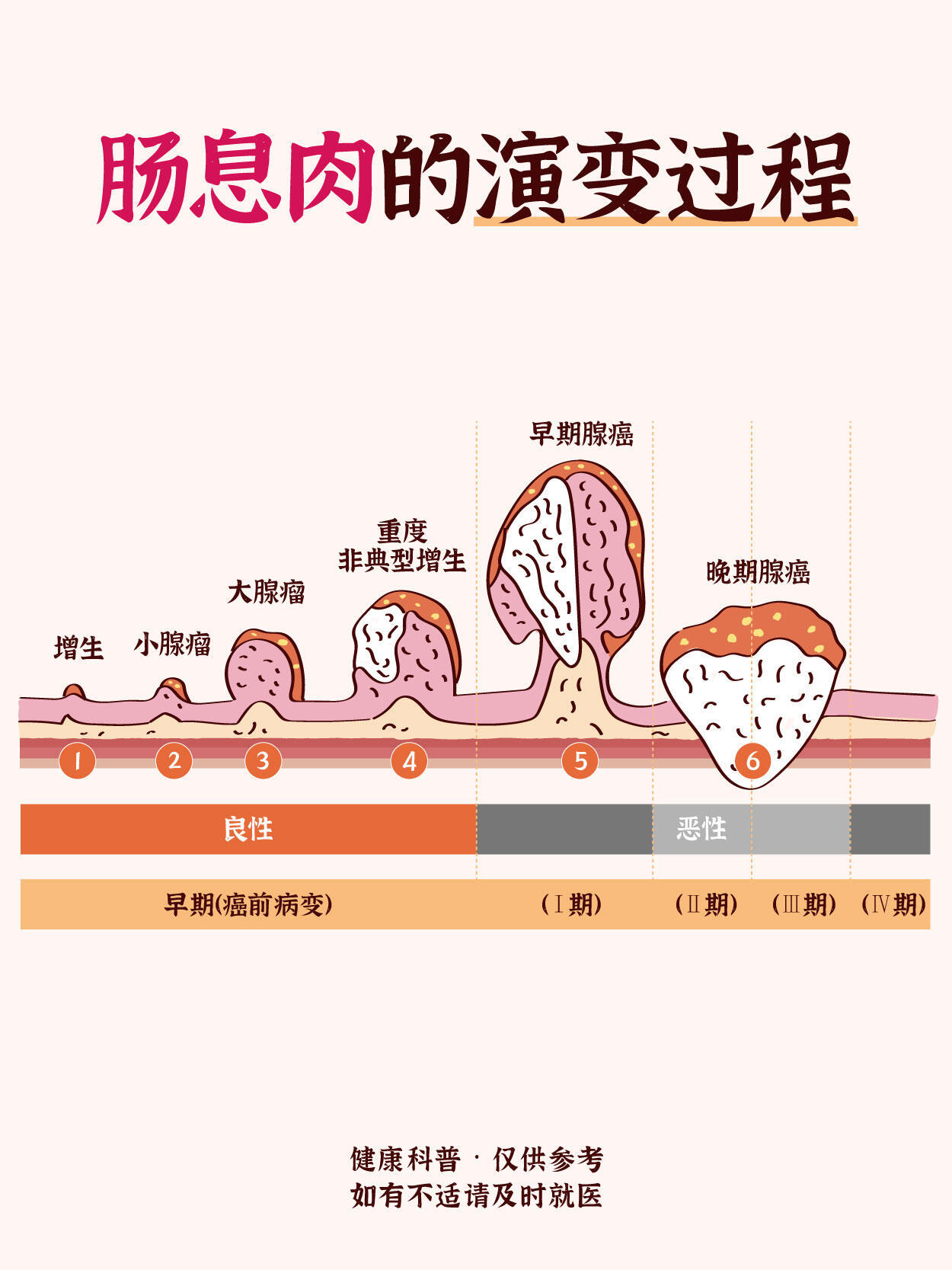 从息肉到肠癌仅4步 肠息肉并非都会癌变，但腺瘤性息肉会经历 “增生→腺瘤→非典型