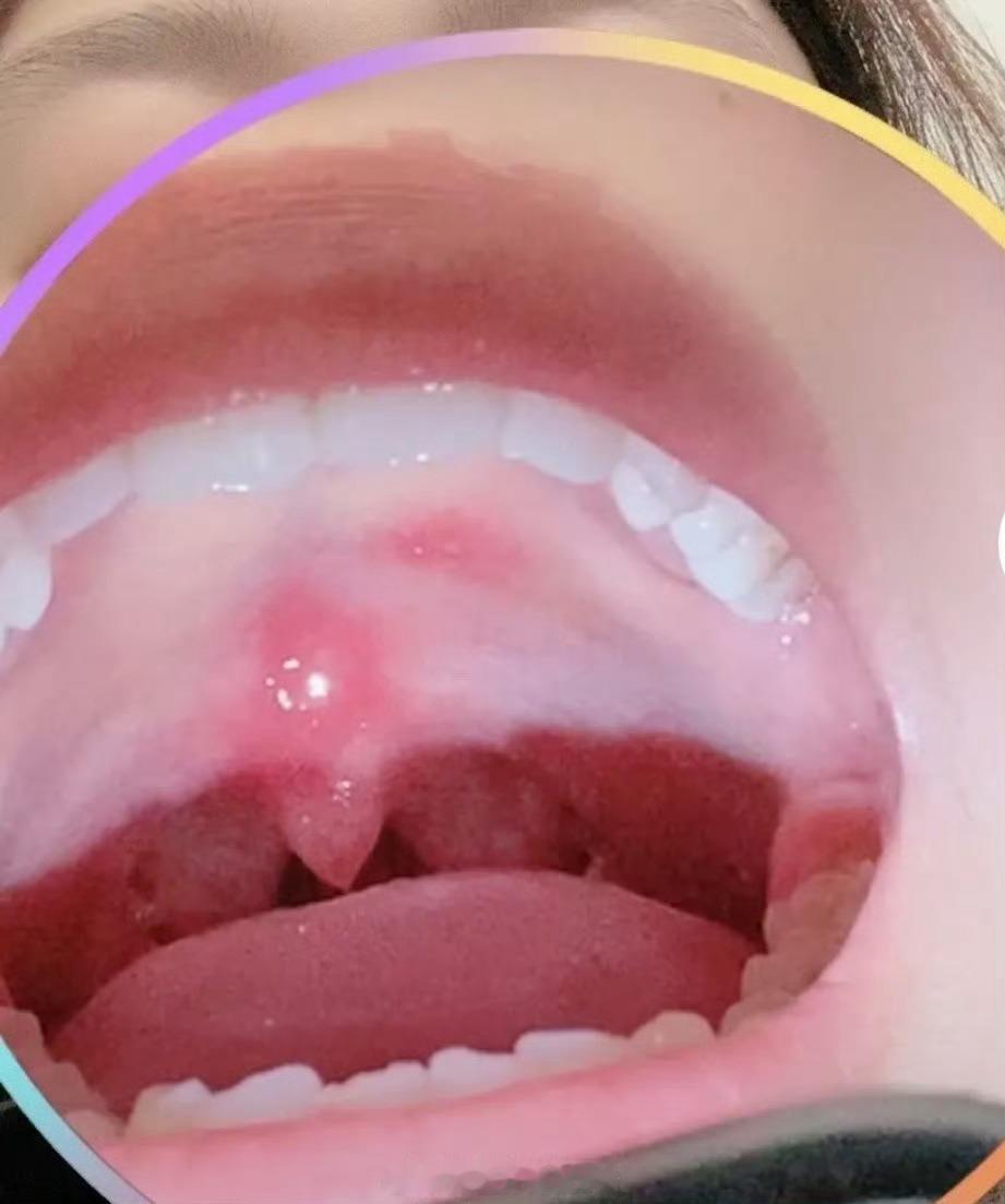 嗓子不舒服，与甲状腺有关吗？双医生，我有甲状腺结节，这几天嗓子干痒的很，这个结节