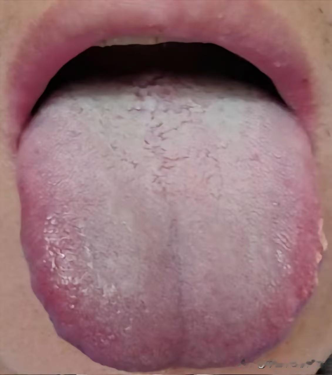 这种舌象千万不能着急补，心肝脾肾，四脏都有问题！

患者主诉：欲望强烈，时间短，