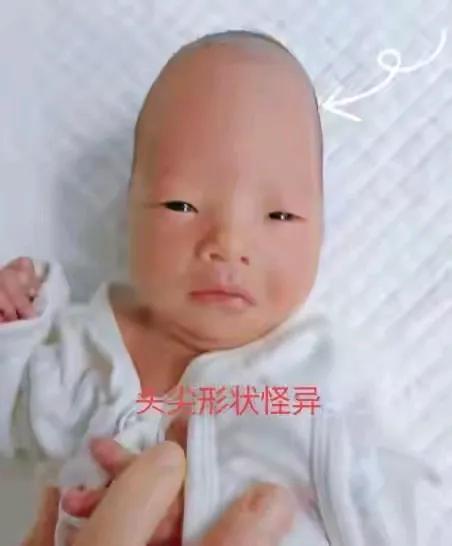 新出生的婴儿头尖形状怪异！河南一对健康的夫妇，婚后四五年了一直都怀不上孩子，而且