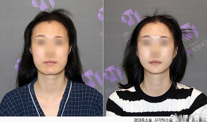 韩国轮廓三件套的同时处理了脂肪 