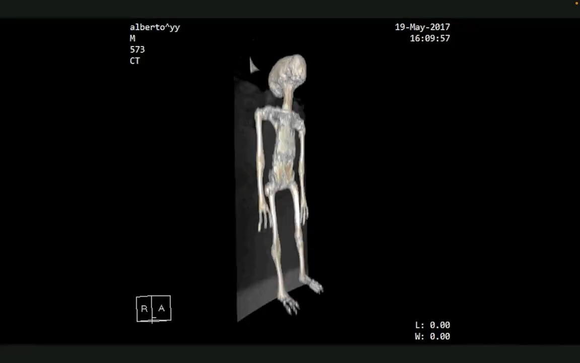 科罗拉多大学医院的放射科医生玛丽·K·杰西博士正在检查被称为“阿尔伯托”的标本的