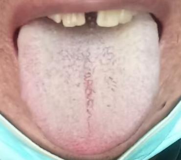 腰间盘突出：补肾是基础，更要燥湿活血通经络






很多人得了腰间盘突出总是