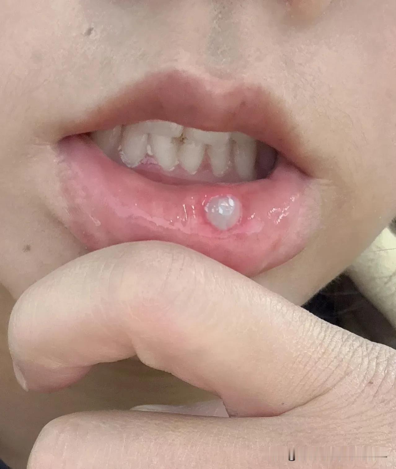 家人们救命！我太容易长口腔溃疡了，一年能犯七八回，每次都得折磨我10来天。这两天