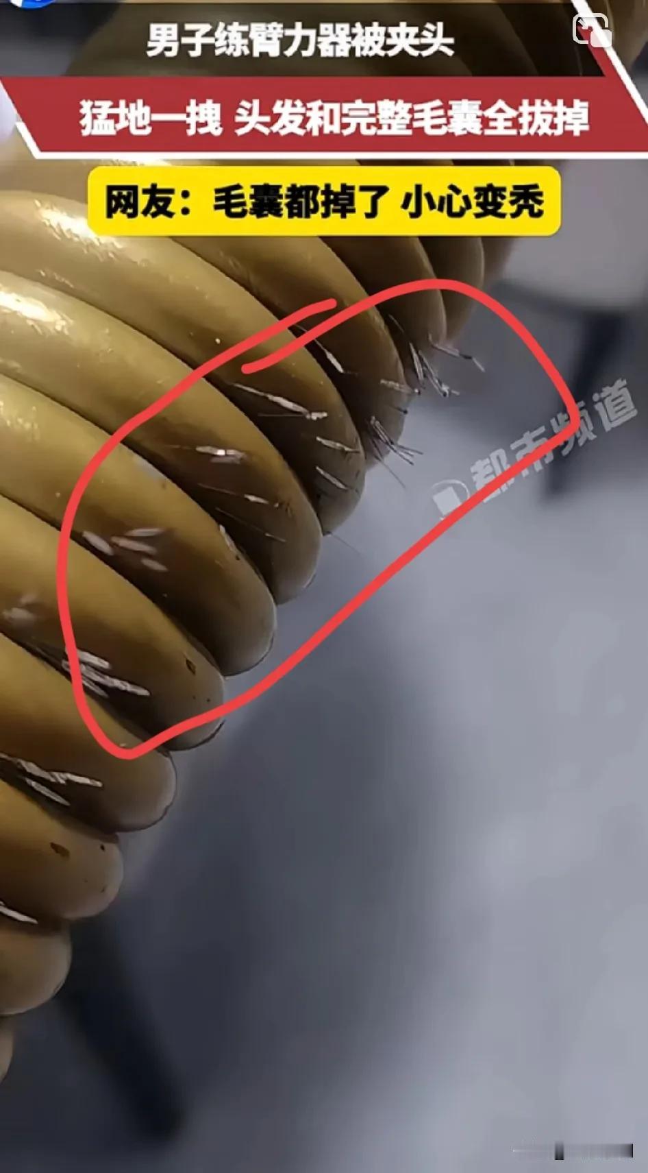 男子反向练臂力器被夹头，猛地一拽  头发和完整毛囊全拔掉，网友：毛囊都掉了 小心