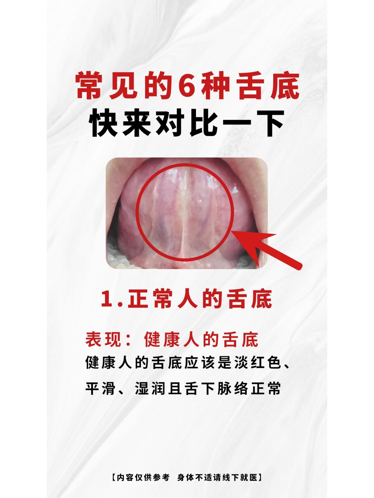 常见的6种舌底，快来对比一下~